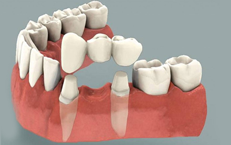 Dental Crowns Nedlands